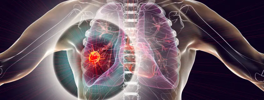 Lutetium-177 Octreotate Therapy, Neuroendocrine Tumours, What to Expect, Patient Journey, Theranostics, Theranostics Singapore, Cancer Treatment, Dr Andrew Tan